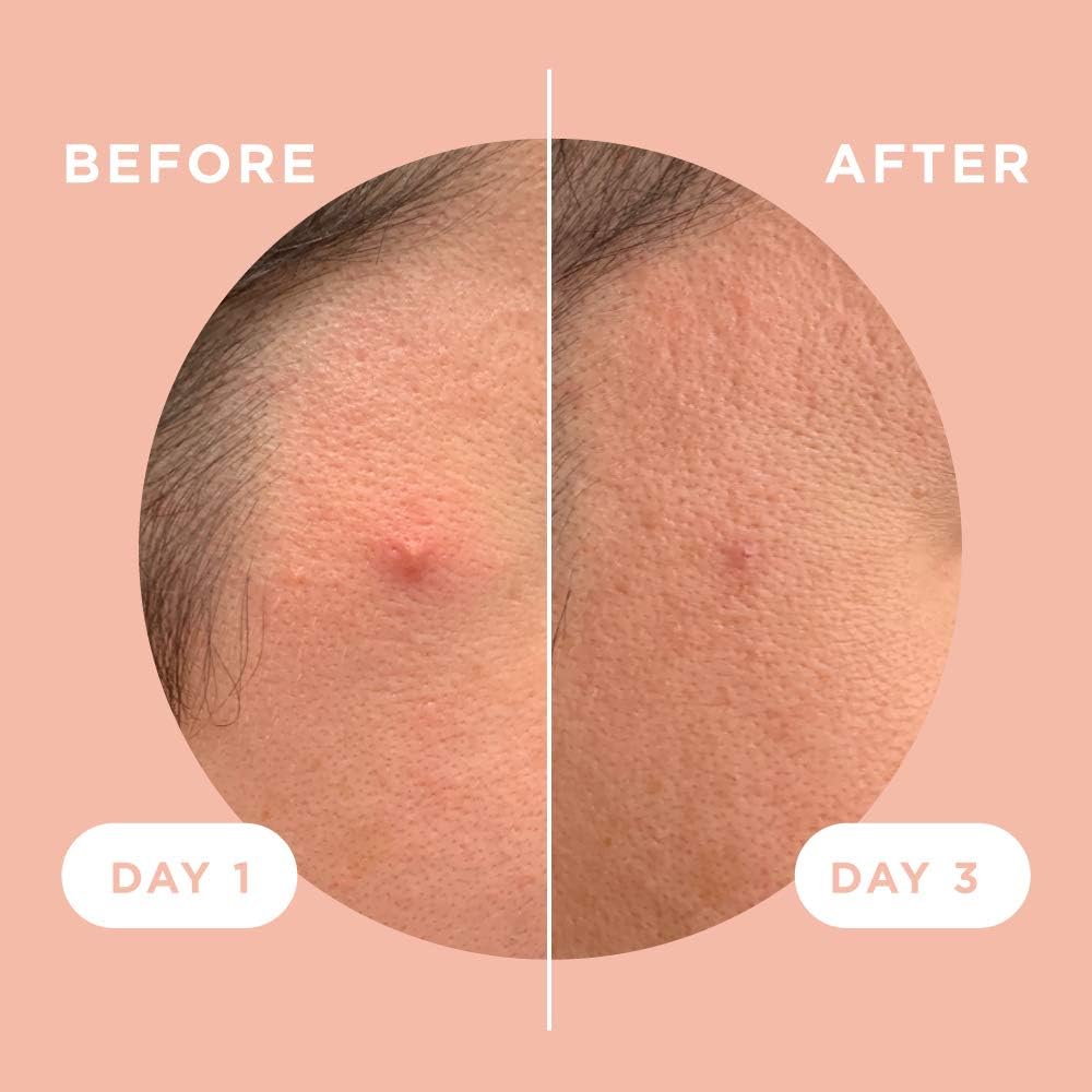 ZitSticka Killa Acne Patches for Face - World's Most Potent Pimple Patch with Fast-Acting Microdarts - Starts Working within 2 Hours for Deep, Early-Stage Zits & Blemish - 4 Count