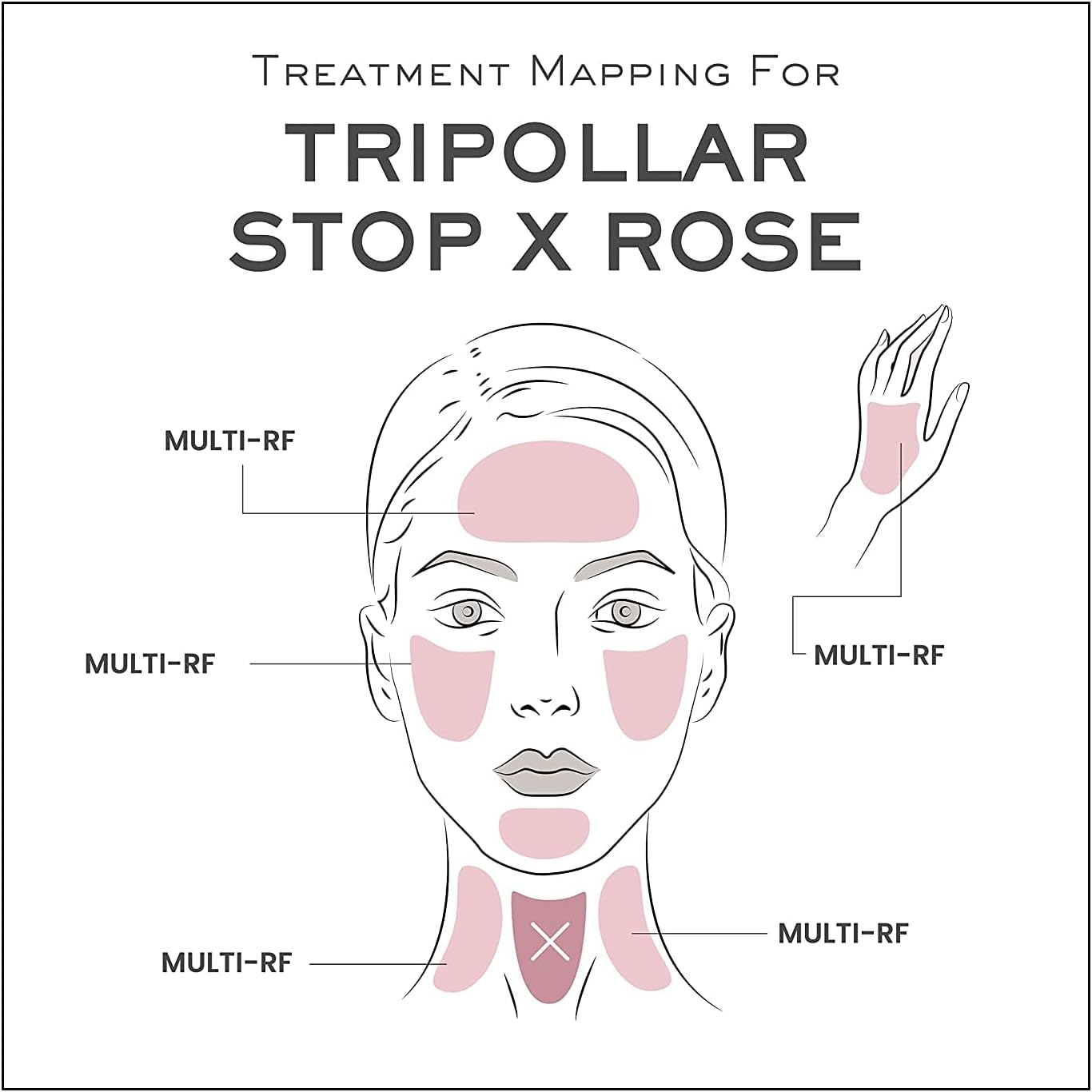 TriPollar Stop X Rose – Radio Frequency Skin Tightening Machine Face & Neck Professional Home RF Anti-Aging Device - Lift Toning Wrinkle Removal Radiofrecuencia Facial Thermal Mapping Algorithm