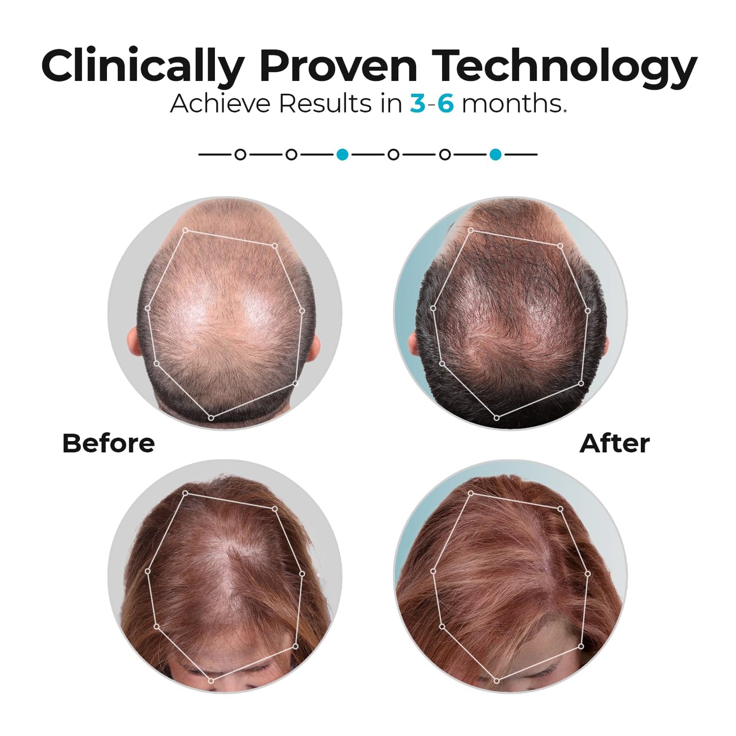 Capillus Pro Mobile Laser Therapy Cap for Hair Regrowth, with 272 Red Light Lasers for Laser Hair Growth, Red Light Hair Growth