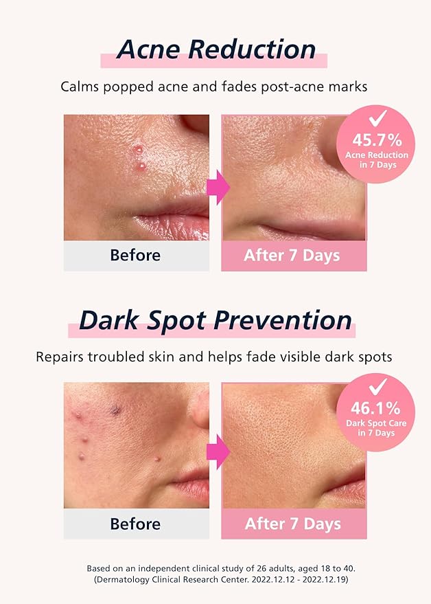 Easyderm Real Calming Patch Pimple Patches, Niacinamide, Hyaluronic Acid, EGF, K-Beauty Skincare | 10 Packs (60 Total) Micro Point length : 285μm