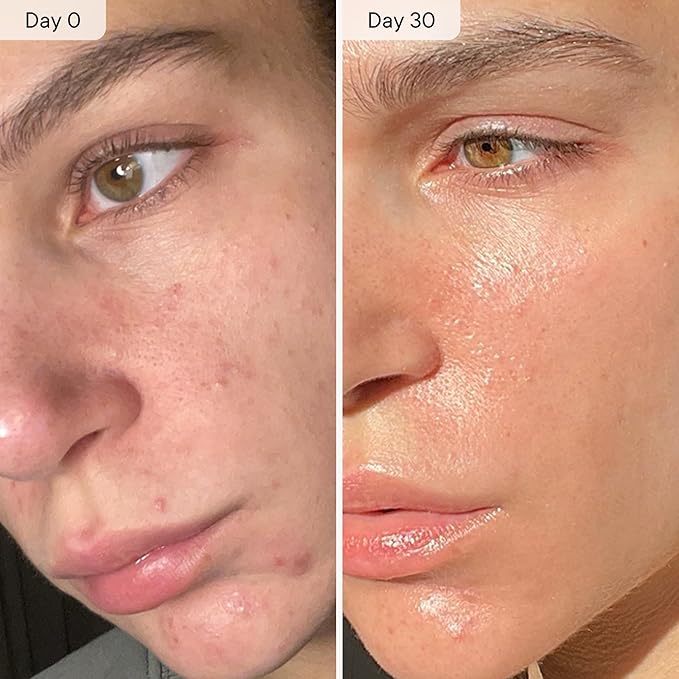 Qure Micro Infusion System for Face & Neck - Facial Moisturizing Essence, Hydrating Serum for All Skin Types, Refreshed Skin - 1-Month Supply