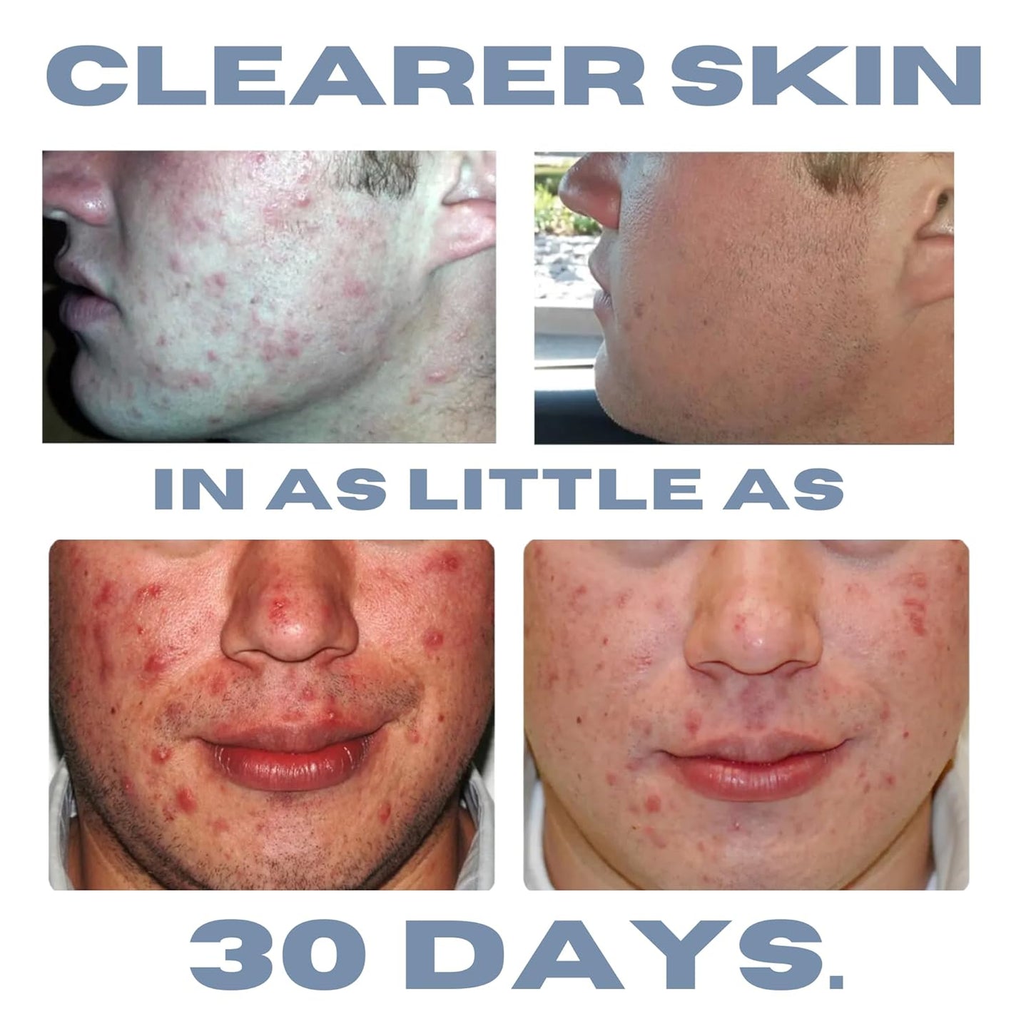 Acne Treatment Kit, Acne Kit, Skin Care Acne, Acne Skin Care Set, Natural Anti-DHT Deluxe Set Original Formula Benzoyl Peroxide 3-Piece Set, 1-Month Supply