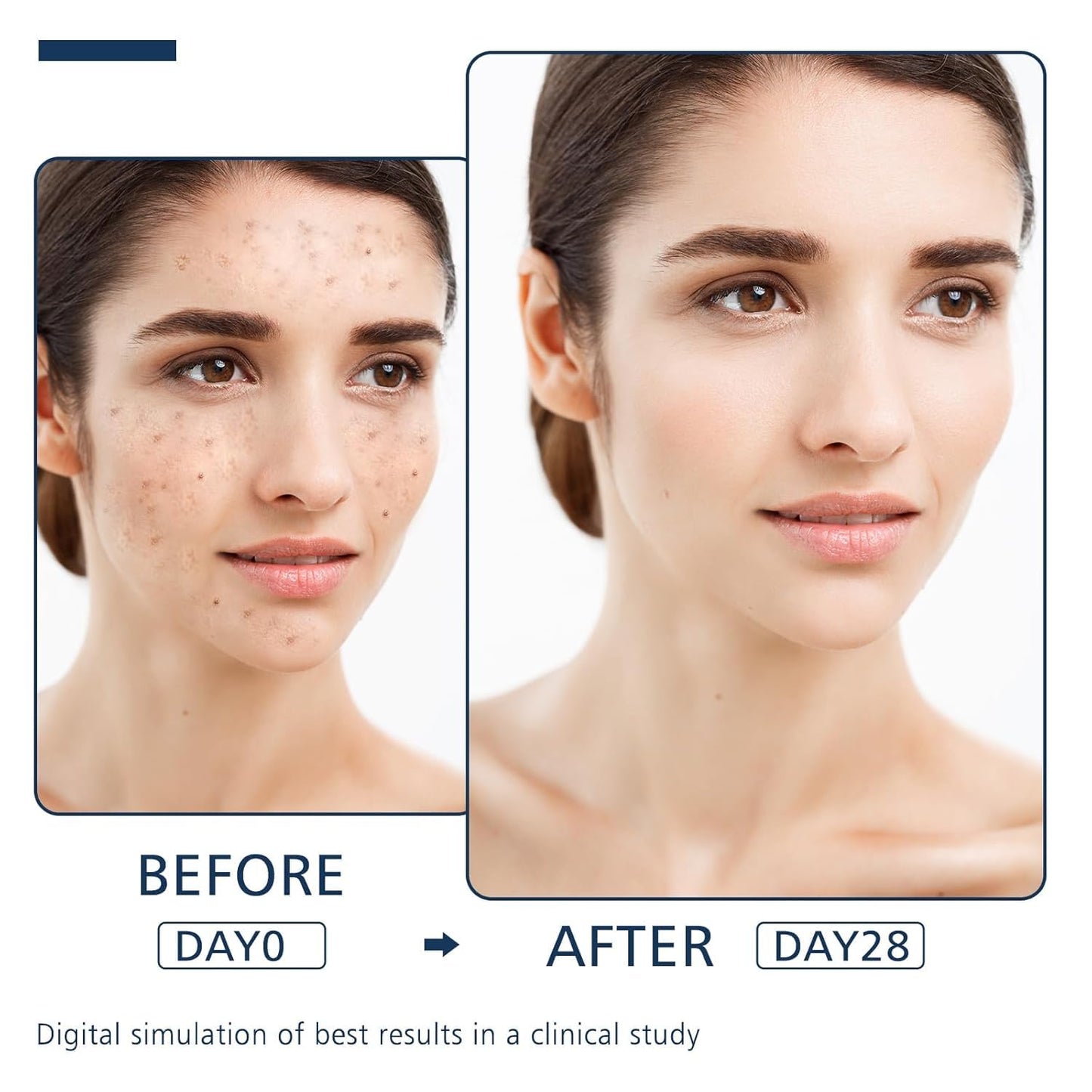 Dark Spot Remover for Face and Body - Dark Spot Advanced Corrector Serum for Melasma, Age Spots, Freckles & Sun Spots, with 360° Roller for All Skin Types