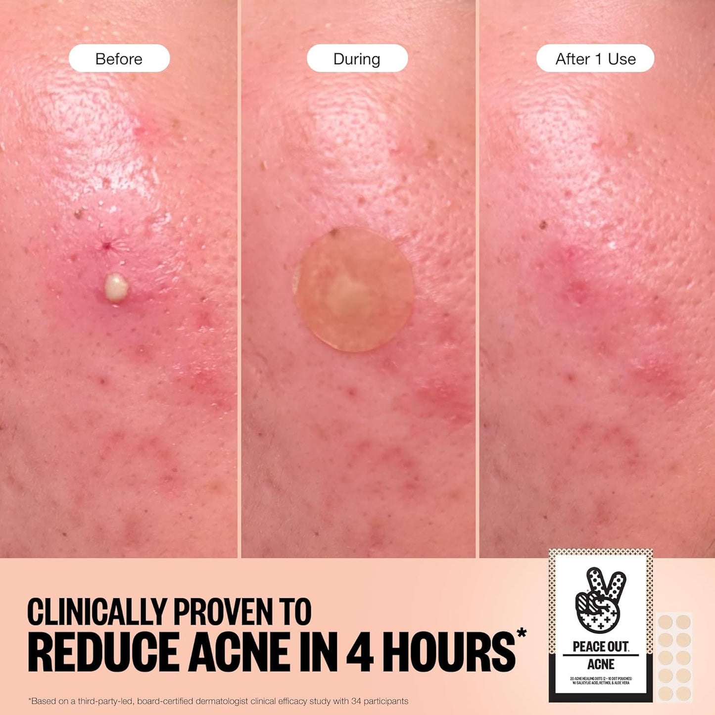 PEACE OUT Acne Healing Dots Helps Clear Blemishes Overnight, Fast Acting Hydrocolloid Pimple Patches for Breakouts with Salicylic Acid, Retinol and Aloe Vera, Award Winning Skincare Solution 40 Count