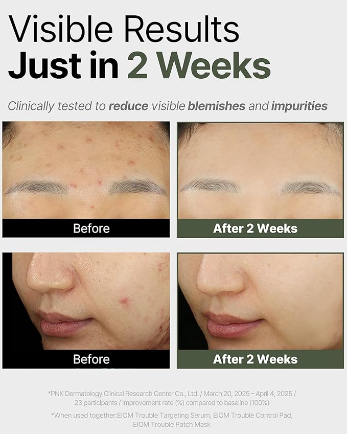 Trouble Patch Mask – Full-Face Acne & Sebum Control Korean Sheet Mask with Tea Tree Biome, Hydrocolloid-Inspired Care for Oily Skin, Visible Sebum Lift, Holiday Skincare Gift | 20ml x 4