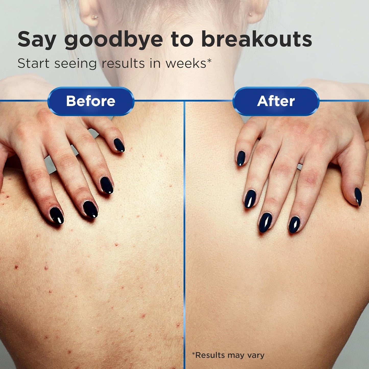 Non-Comedogenic & Sulfate-Free Shampoo & Conditioner Set by Clear 2 Perfection, Ideal for Acne-Prone Skin & Bacne, Esthetician Developed, Fights Breakouts & Promotes Healthy Hair