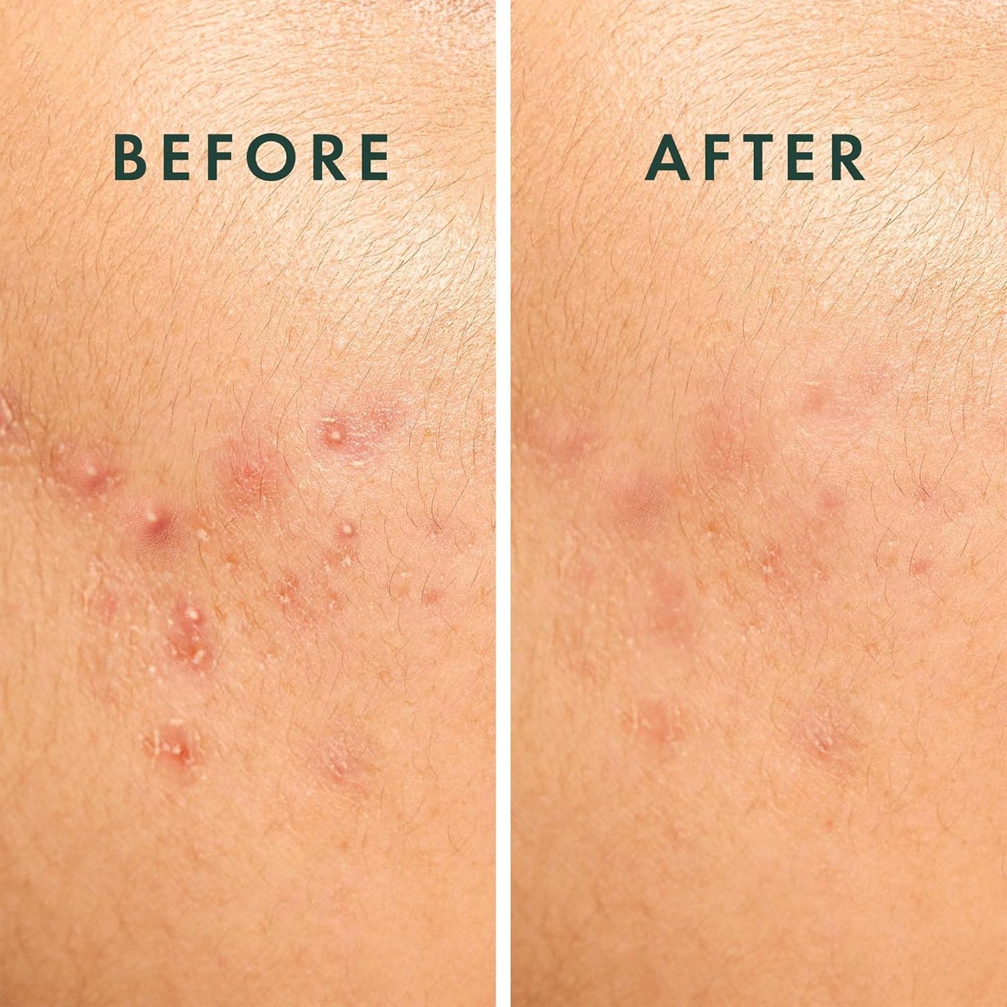 Rael Pimple Patches, Miracle Spot Control Cover - Hydrocolloid Acne Patch, Strips for Zits and Blemish, Korean Skin Care, Vegan, Cruelty Free (10 Count)