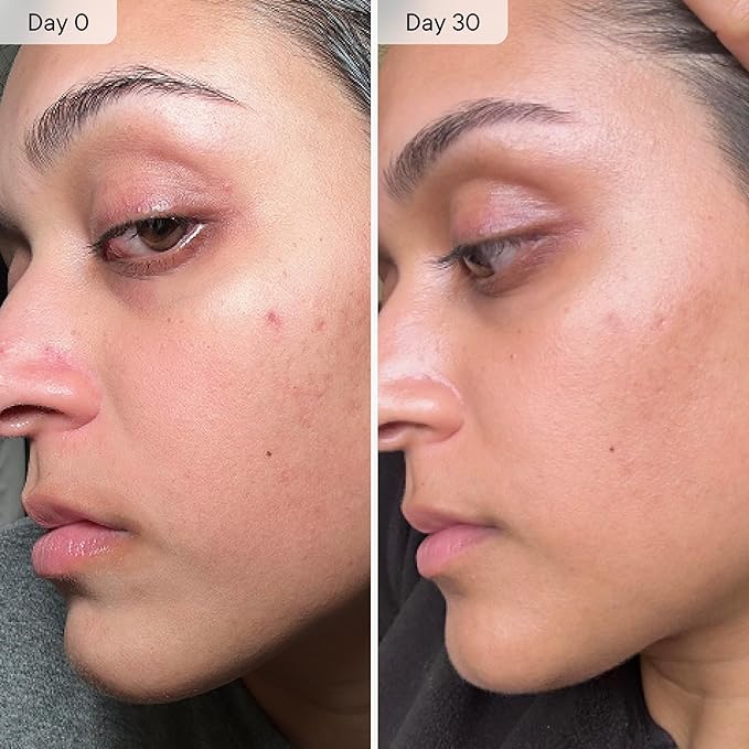 Qure Micro Infusion System for Face & Neck - Facial Moisturizing Essence, Hydrating Serum for All Skin Types, Refreshed Skin - 3-Month Supply