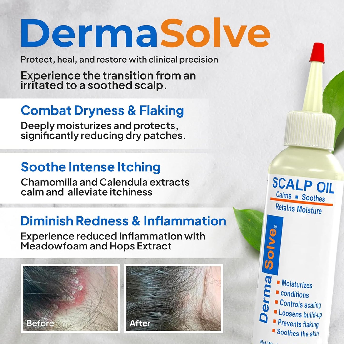 Dermasolve 4 oz Psoriasis, Seborrheic Dermatitis, & Dandruff Scalp Oil - Dermatologist Approved - Flaky Scalp Relief, Clinically Tested, Long-Lasting Itch-Free, High-Performance Formula