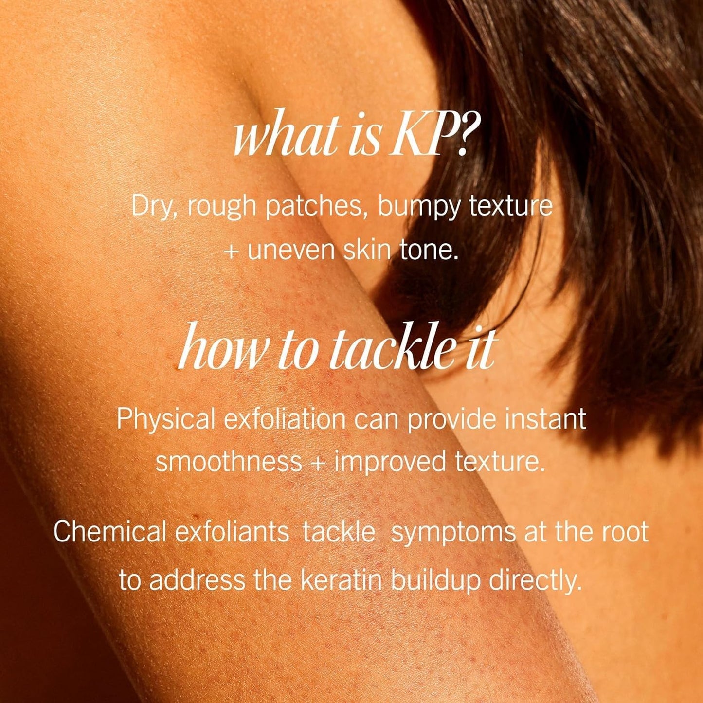 First Aid Beauty - KP Bump Eraser Body Scrub with 10% AHA, Keratosis Pilaris Skin Exfoliator with Glycolic and Lactic acids, Helps Reduce Chicken Skin Bumps, Safe for Sensitive Skin, 8 oz