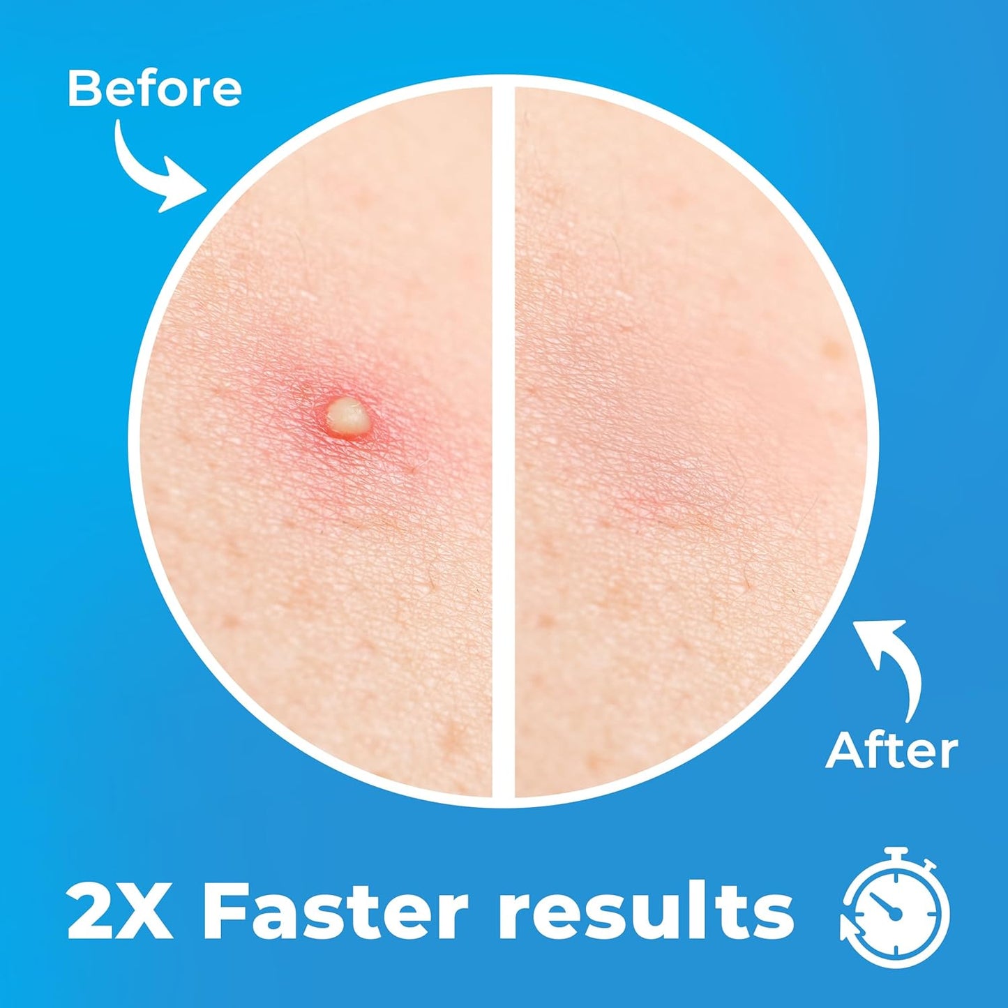 Pimple Patches for Face (500 Patches), Hydrocolloid Acne Patches with Tea Tree Oil, Pimple Patch Pimple Stickers - Hydrocolloid Patch Acne Dots - Acne Pimple Patches For Face - Zit Patches